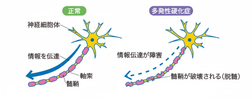 多発性硬化症（MS）
