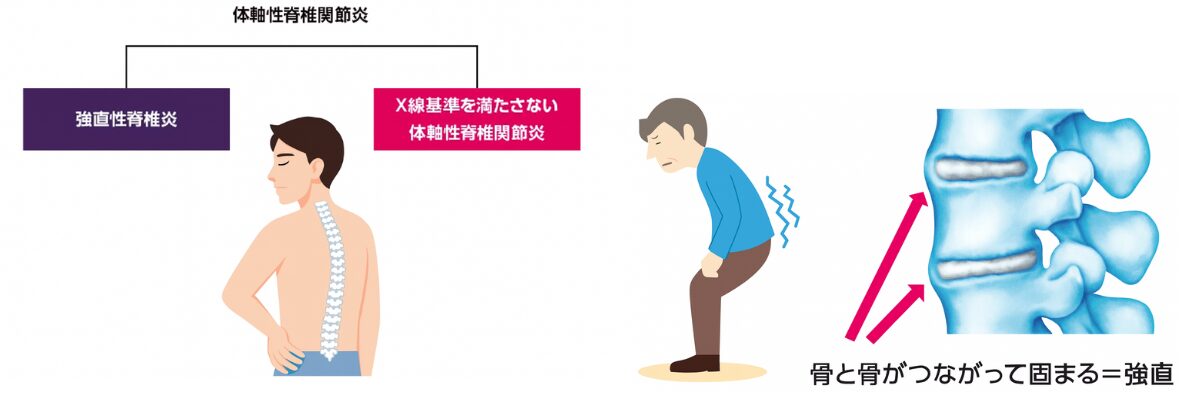 体軸性脊椎関節炎