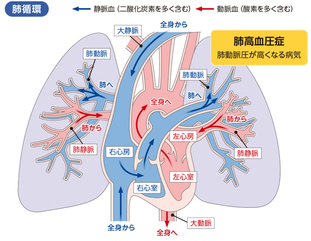 肺高血圧症（PH）について