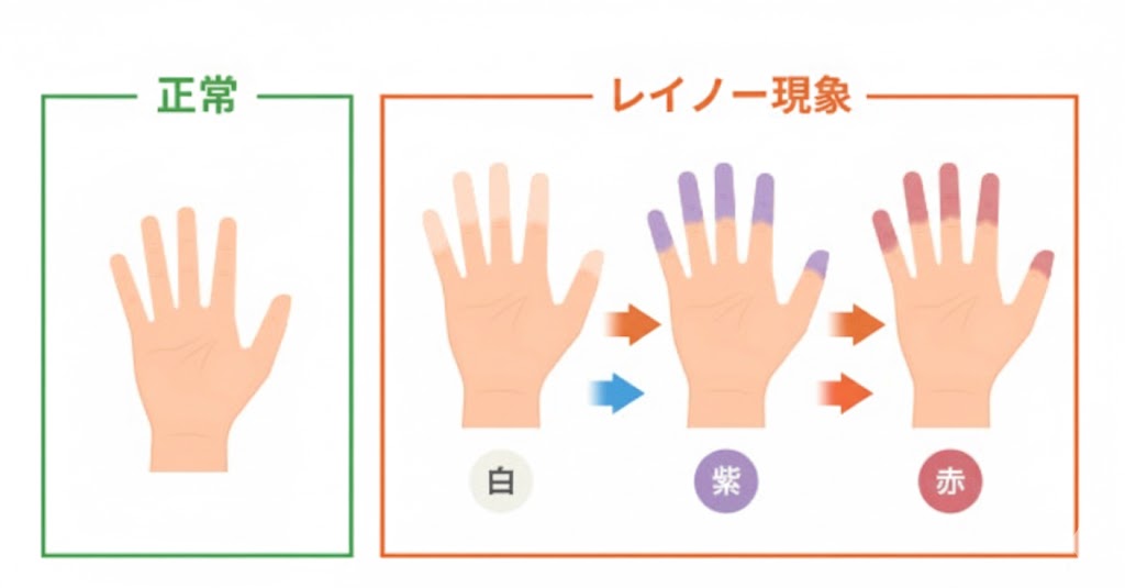 強皮症　レイノー現象