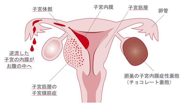 子宮内膜症とは